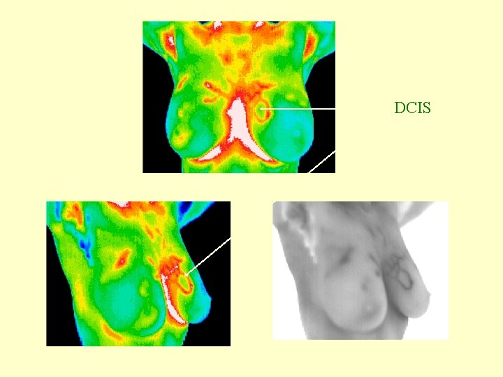 DCIS Greyscale 