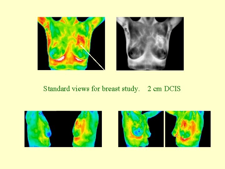Standard views for breast study. 2 cm DCIS 