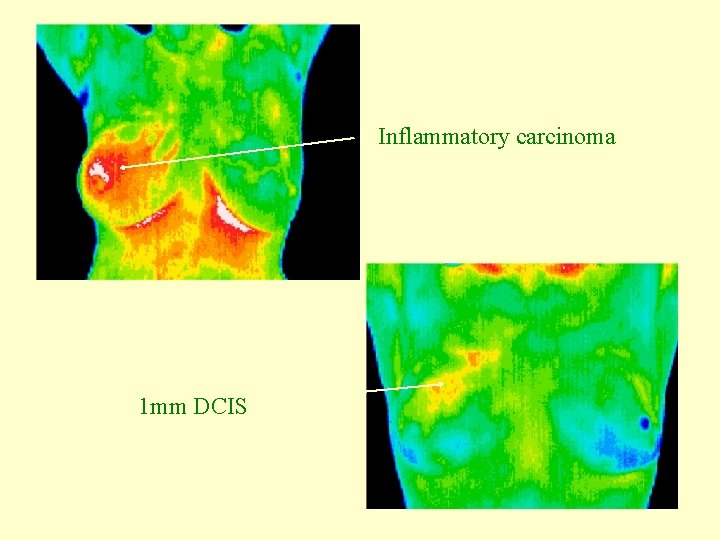 Inflammatory carcinoma 1 mm DCIS 