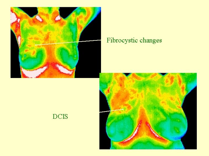 Fibrocystic changes DCIS 
