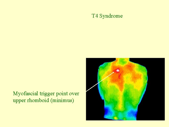 T 4 Syndrome Myofascial trigger point over upper rhomboid (minimus) 
