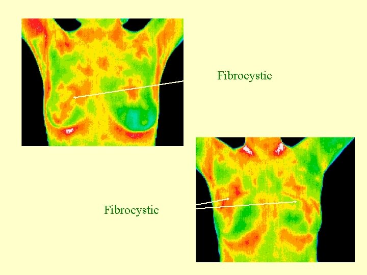 Fibrocystic 
