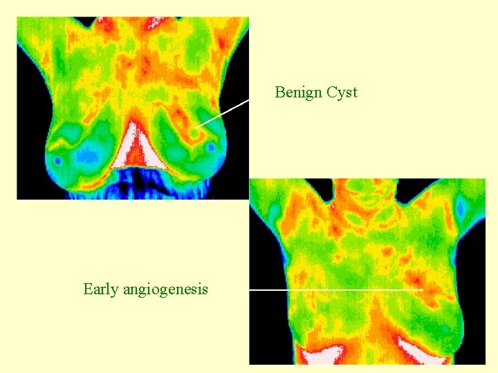 Benign Cyst Early angiogenesis 