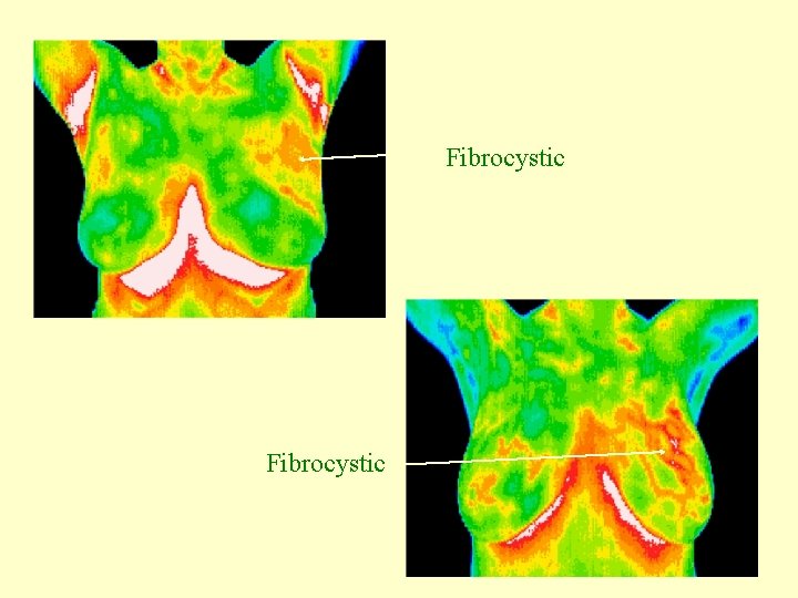 Fibrocystic 