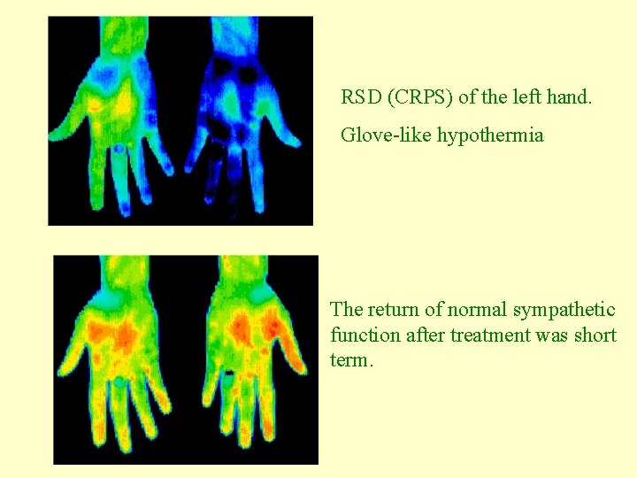 RSD (CRPS) of the left hand. Glove-like hypothermia. The return of normal sympathetic function