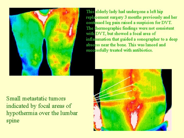 This elderly lady had undergone a left hip replacement surgery 3 months previously and