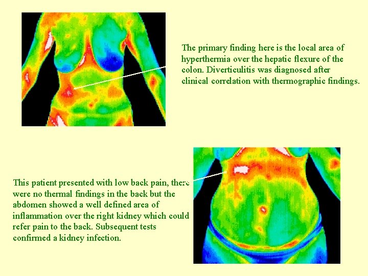The primary finding here is the local area of hyperthermia over the hepatic flexure