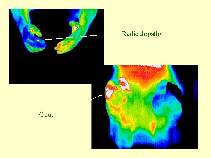 Radiculopathy Gout 