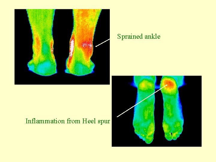 Sprained ankle Inflammation from Heel spur 