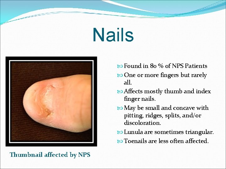 Nails Found in 80 % of NPS Patients One or more fingers but rarely