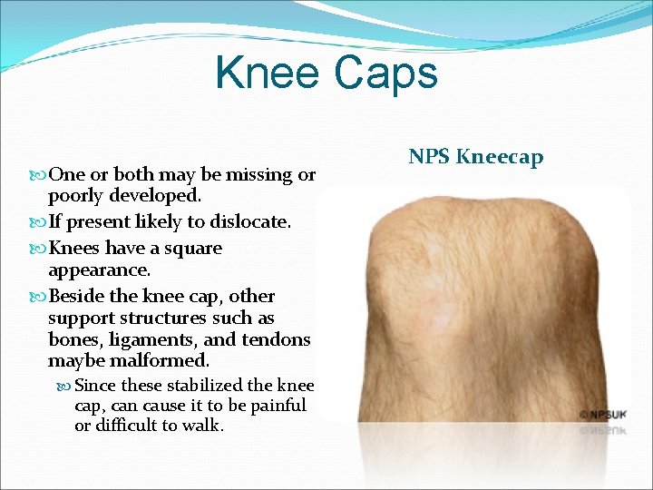 Knee Caps One or both may be missing or poorly developed. If present likely