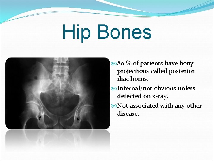 Hip Bones 80 % of patients have bony projections called posterior iliac horns. Internal/not