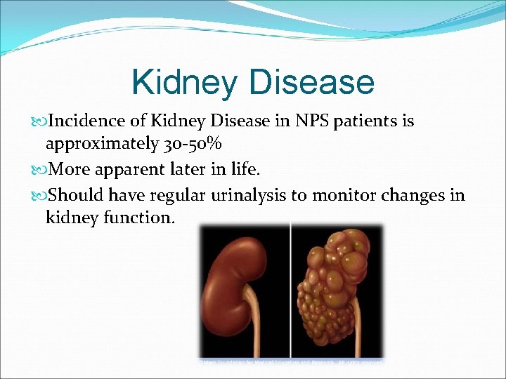 Kidney Disease Incidence of Kidney Disease in NPS patients is approximately 30 -50% More