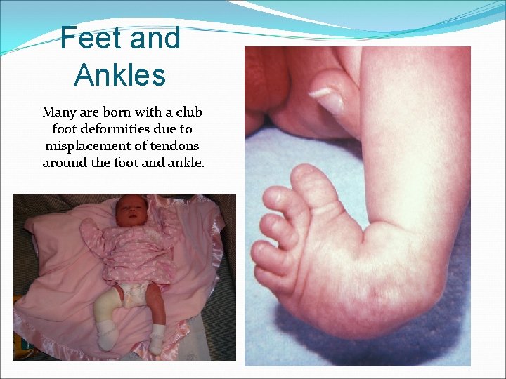 Feet and Ankles Many are born with a club foot deformities due to misplacement