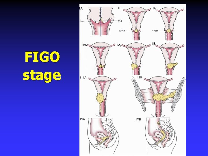 FIGO stage 