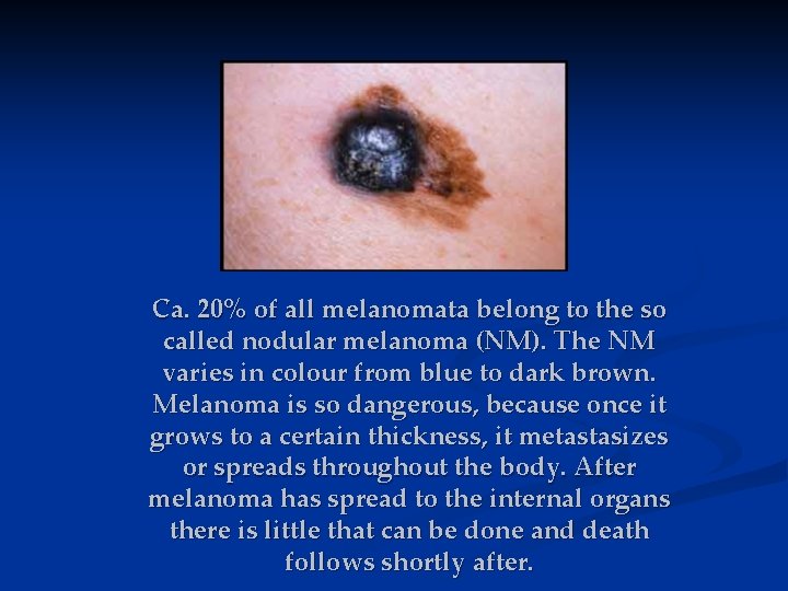 Ca. 20% of all melanomata belong to the so called nodular melanoma (NM). The