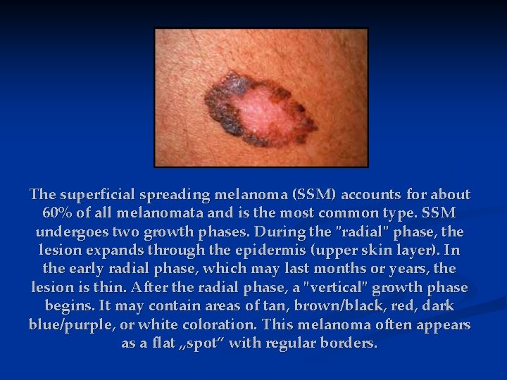 The superficial spreading melanoma (SSM) accounts for about 60% of all melanomata and is