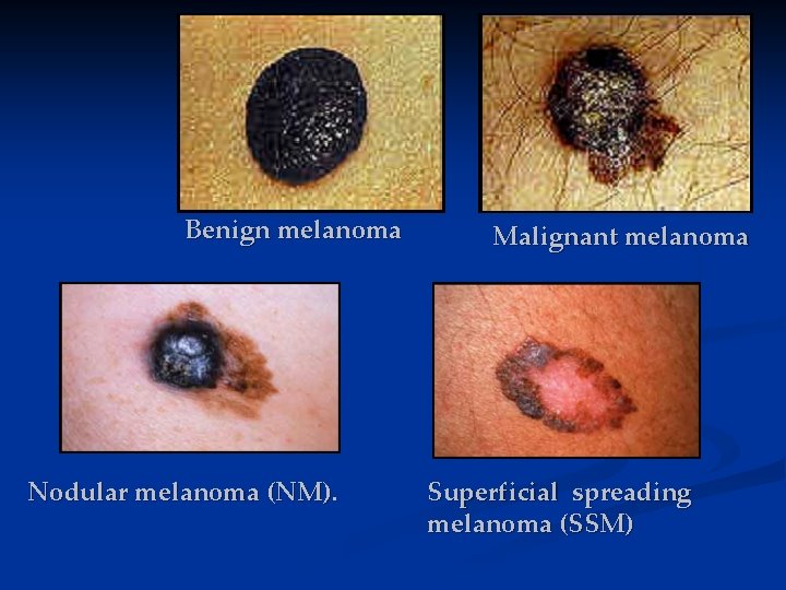 Benign melanoma Nodular melanoma (NM) Malignant melanoma Superficial spreading melanoma (SSM) 