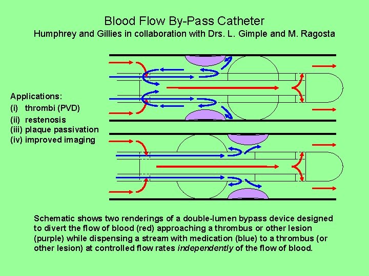 Blood Flow By-Pass Catheter Humphrey and Gillies in collaboration with Drs. L. Gimple and