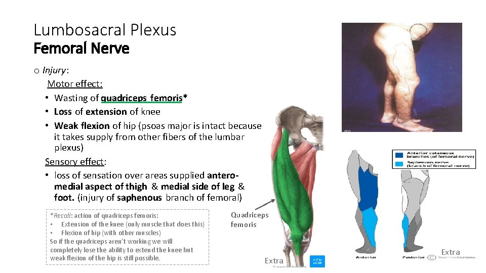 Lumbosacral Plexus Femoral Nerve o Injury: Motor effect: • Wasting of quadriceps femoris* •