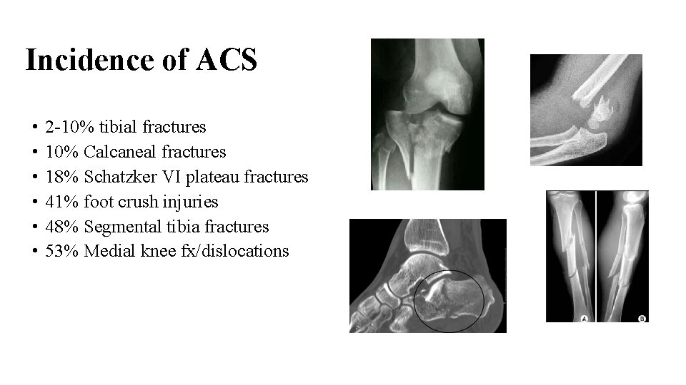 Incidence of ACS • • • 2 -10% tibial fractures 10% Calcaneal fractures 18%