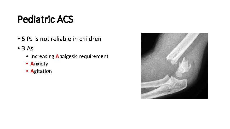 Pediatric ACS • 5 Ps is not reliable in children • 3 As •