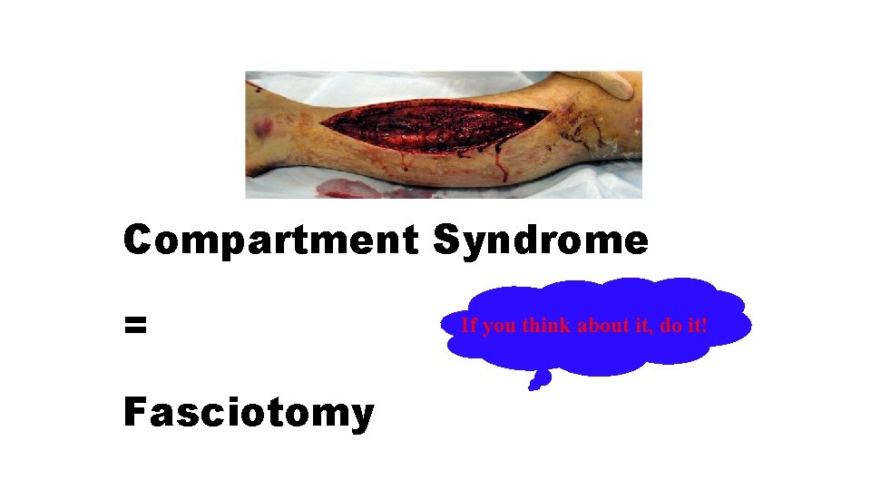 Compartment Syndrome = Fasciotomy If you think about it, do it! 