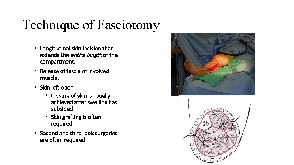 Technique of Fasciotomy • Longitudinal skin incision that extends the entire length of the