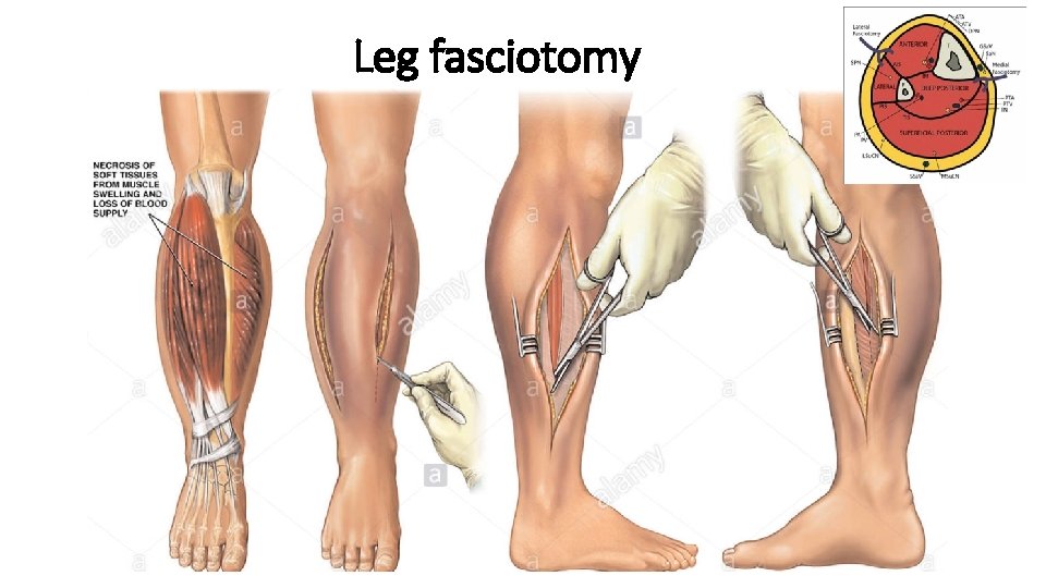 Leg fasciotomy 