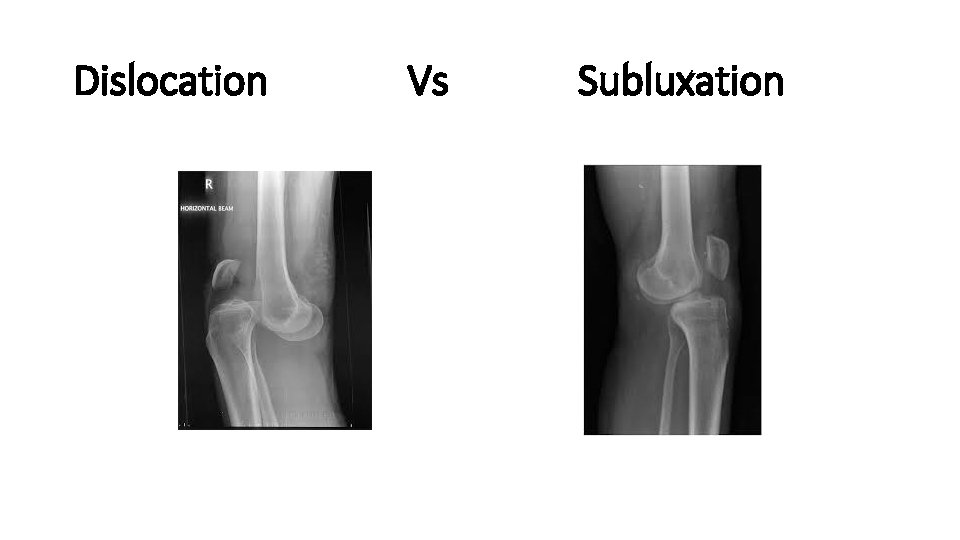 Dislocation Vs Subluxation 
