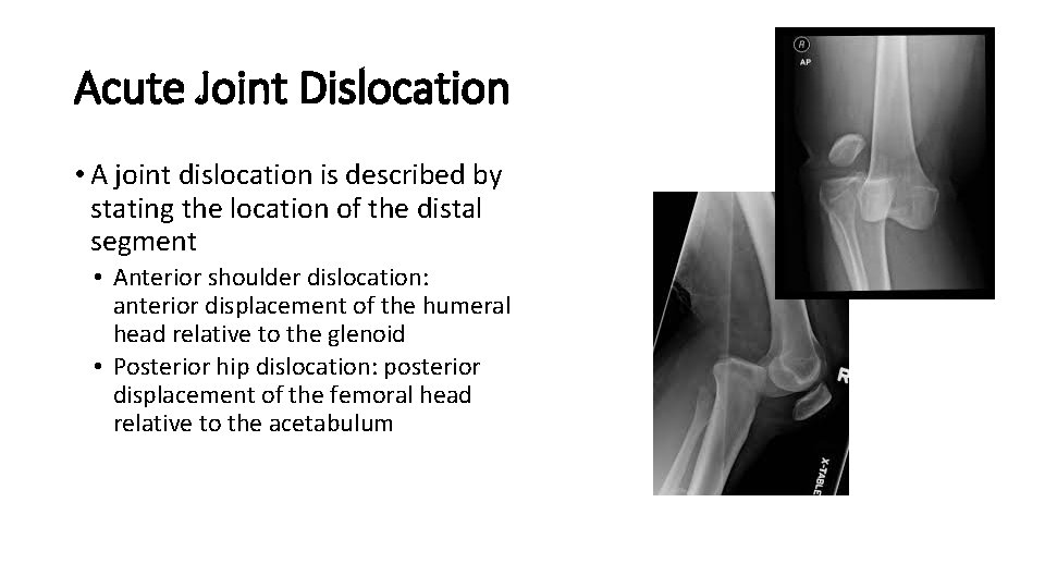 Acute Joint Dislocation • A joint dislocation is described by stating the location of