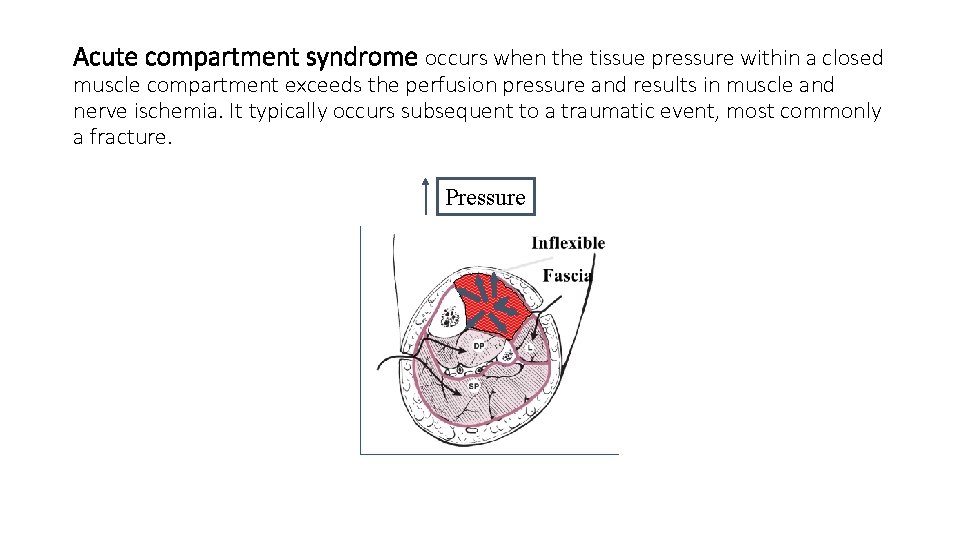 Acute compartment syndrome occurs when the tissue pressure within a closed muscle compartment exceeds