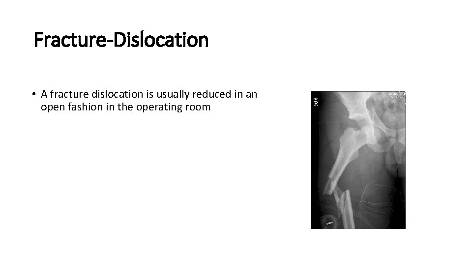 Fracture-Dislocation • A fracture dislocation is usually reduced in an open fashion in the