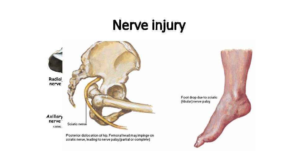 Nerve injury 