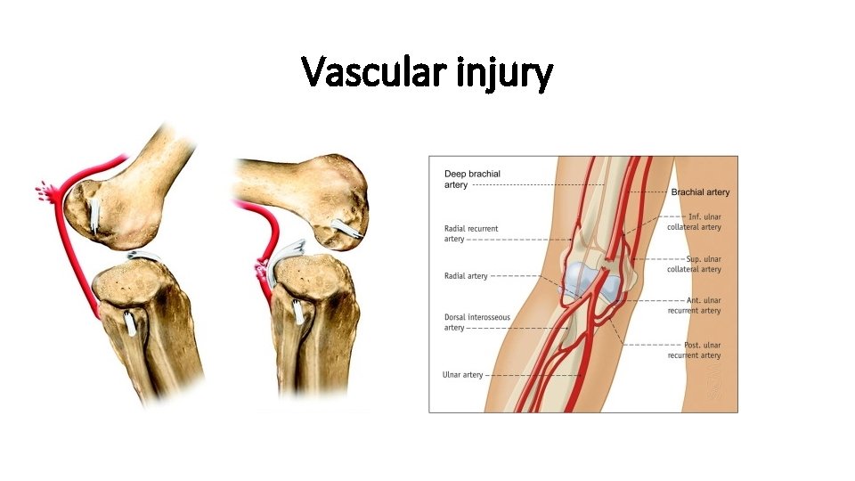Vascular injury 