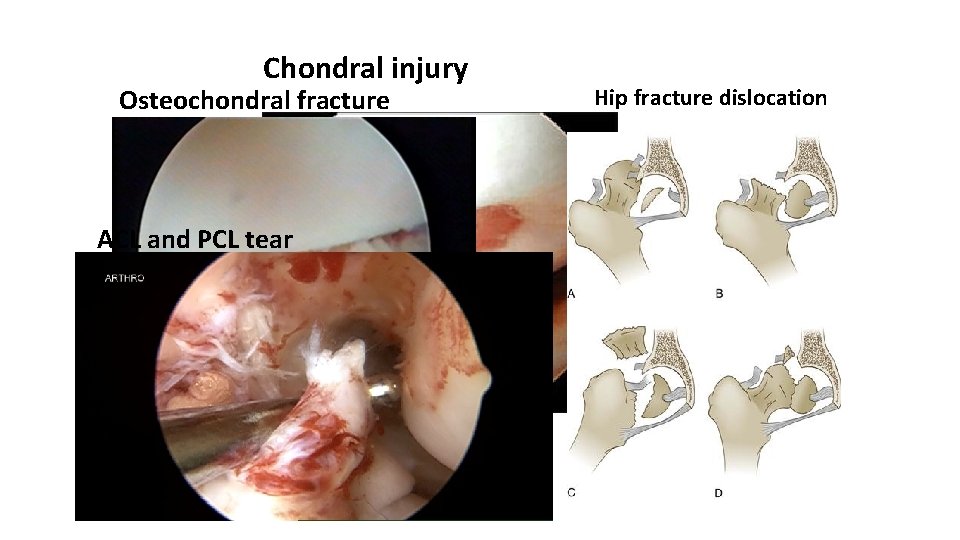 Chondral injury Osteochondral fracture ACL and PCL tear Hip fracture dislocation 