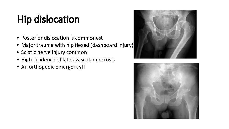 Hip dislocation • • • Posterior dislocation is commonest Major trauma with hip flexed