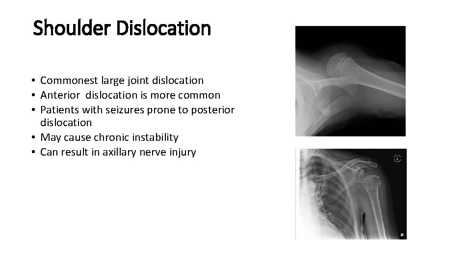 Shoulder Dislocation • Commonest large joint dislocation • Anterior dislocation is more common •