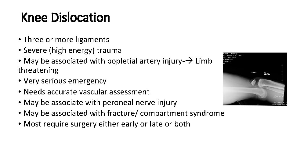 Knee Dislocation • Three or more ligaments • Severe (high energy) trauma • May