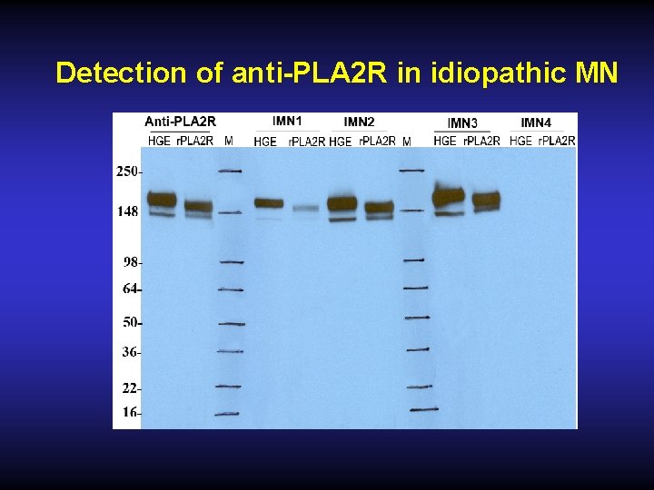Detection of anti-PLA 2 R in idiopathic MN 