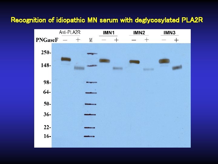 Recognition of idiopathic MN serum with deglycosylated PLA 2 R 