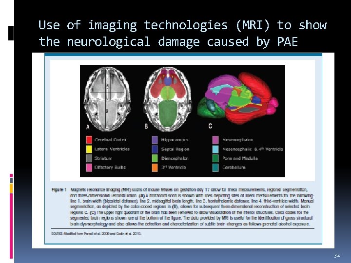 Use of imaging technologies (MRI) to show the neurological damage caused by PAE 32