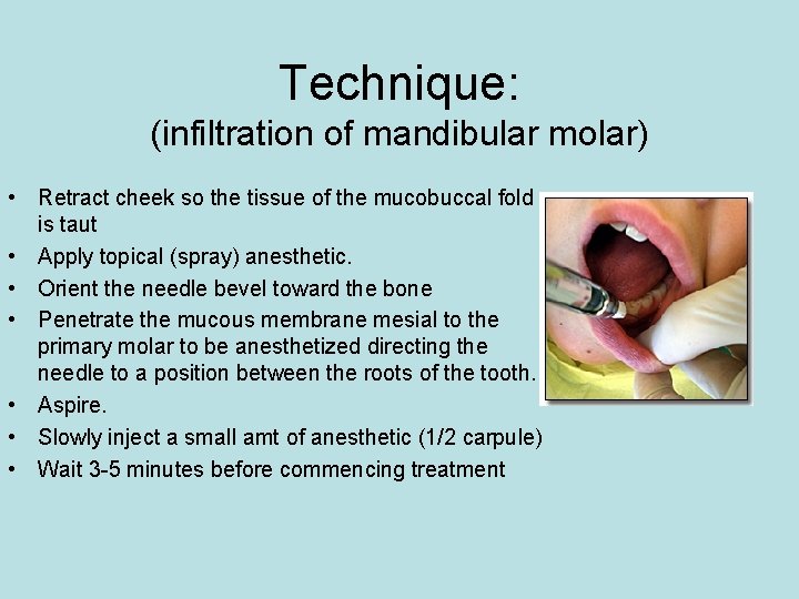 Technique: (infiltration of mandibular molar) • Retract cheek so the tissue of the mucobuccal