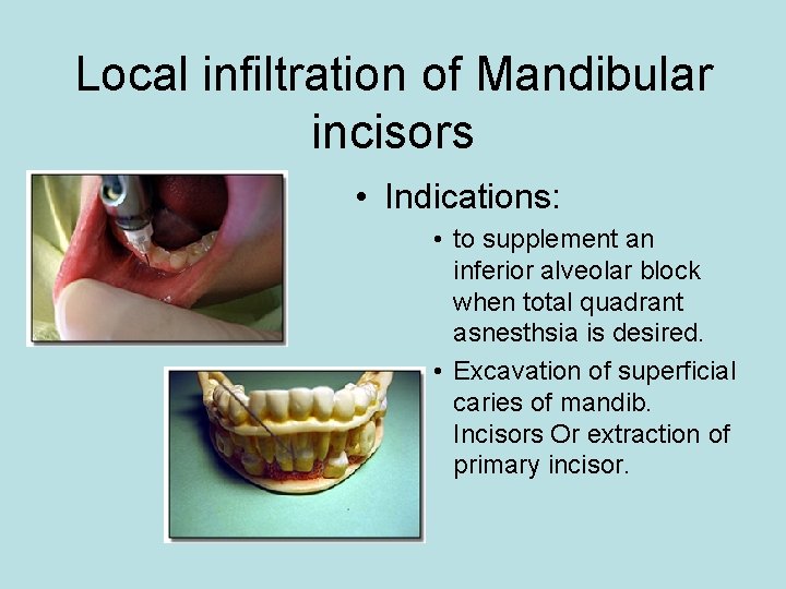 Local infiltration of Mandibular incisors • Indications: • to supplement an inferior alveolar block