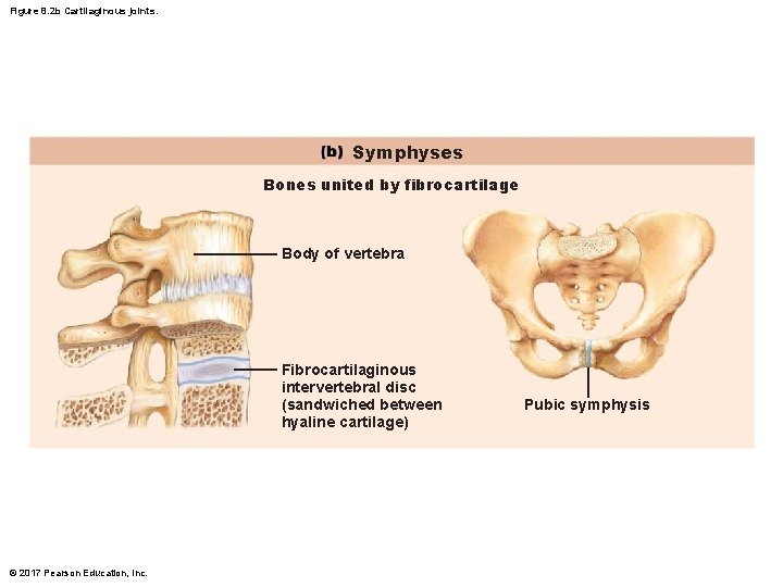 Figure 8. 2 b Cartilaginous joints. Symphyses Bones united by fibrocartilage Body of vertebra