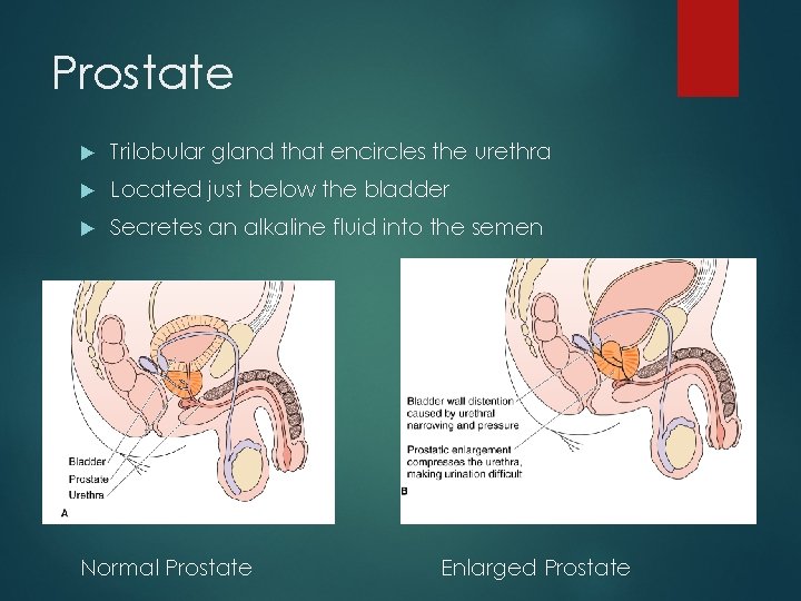 Prostate Trilobular gland that encircles the urethra Located just below the bladder Secretes an
