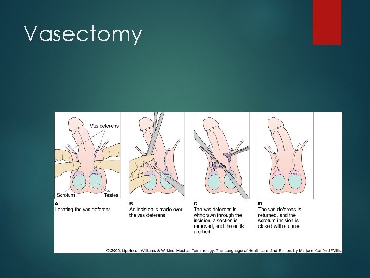 Vasectomy 