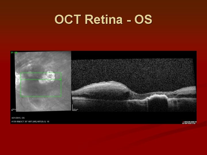 OCT Retina - OS 