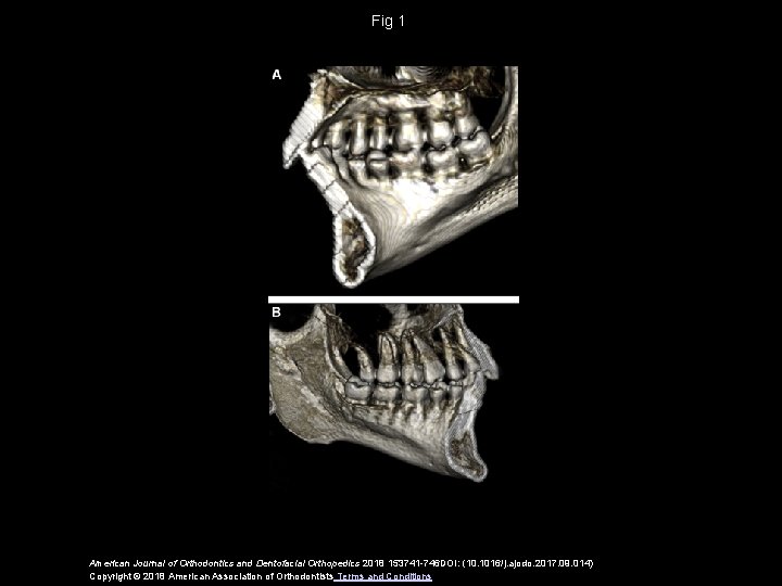 Fig 1 American Journal of Orthodontics and Dentofacial Orthopedics 2018 153741 -746 DOI: (10.