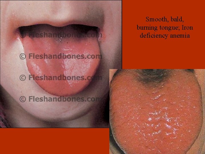 Smooth, bald, burning tongue; Iron deficiency anemia 